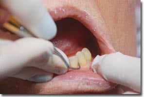 Raspagem Dentária